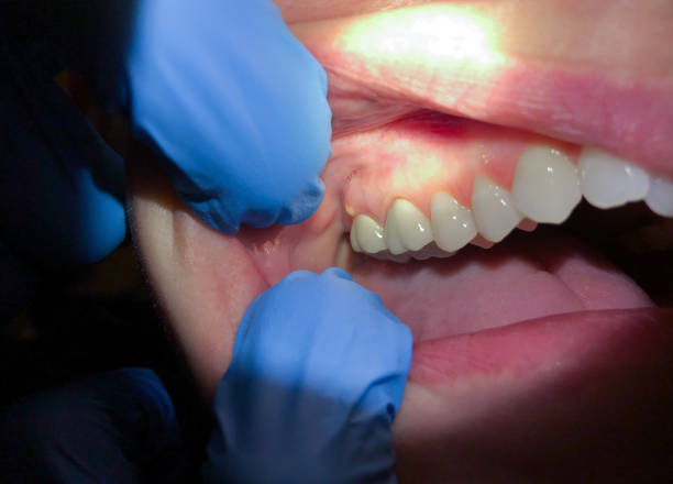 Best Emergency Wisdom Tooth Extraction in Hampton Manor, NY